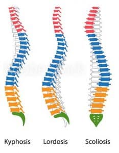 kyphosis, skoliosis, lordosis